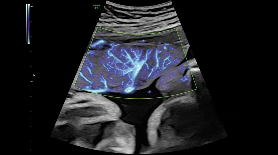 placenta-with-slowflowhd.jpg