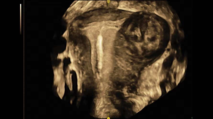 gallery_0007_iud-and-fibroid-with-omniview.png gallery_0007_iud-and-fibroid-with-omniview.png